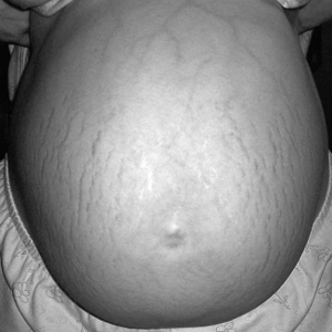 A pregnant woman is pregnant again… at the same time, and they aren't twins! (Photo: wikipedia.org)